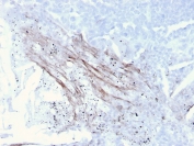 IHC staining of FFPE human lung carcinoma with Tenascin C antibody (clone rTNC/3635). HIER: boil tissue sections in pH 9 10mM Tris with 1mM EDTA for 10-20 min and allow to cool before testing.