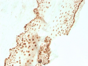 IHC staining of FFPE human cervical carcinoma with recombinant SOX2 antibody (clone SOX2/3811R). HIER: boil tissue sections in pH 9 10mM Tris with 1mM EDTA for 10-20 min and allow to cool before testing.~