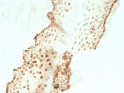IHC staining of FFPE human cervical carcinoma with recombinant SOX2 antibody (clone SOX2/3811R). HIER: boil tissue sections in pH 9 10mM Tris with 1mM EDTA for 10-20 min and allow to cool before testing.