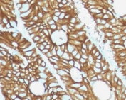 IHC staining of FFPE human colon with Cadherin 17 antibody (clone CDN17-1). HIER: boil tissue sections in pH 9 10mM Tris with 1mM EDTA for 10-20 min and allow to cool before testing.