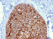 IHC staining of FFPE human breast carcinoma with HER-2 antibody (clone ERBB2/3080). HIER: boil tissue sections in pH 9 10mM Tris with 1mM EDTA for 10-20 min and allow to cool before testing.