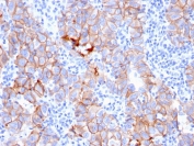 IHC staining of FFPE human breast carcinoma with HER-2 antibody (clone ERBB2/3080). HIER: boil tissue sections in pH 9 10mM Tris with 1mM EDTA for 10-20 min and allow to cool before testing.