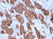 IHC staining of FFPE human breast carcinoma with HER-2 antibody (clone ERBB2/3093). HIER: boil tissue sections in pH 9 10mM Tris with 1mM EDTA for 10-20 min and allow to cool before testing.