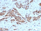 IHC staining of FFPE human breast with ARF1 antibody (clone ARF1/2117). HIER: boil tissue sections in pH 9 10mM Tris with 1mM EDTA for 20 min and allow to cool before testing.