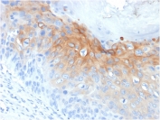 IHC staining of FFPE human cervical carcinoma with CK1 antibody (clone KRT1/1840). HIER: boil tissue sections in pH 9 10mM Tris with 1mM EDTA for 20 min and allow to cool before testing.