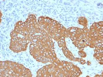 IHC staining of FFPE human basal cell carcinoma with Cytokeratin 5 antibody (clone KRT5/2080). HIER: boil tissue sections in pH 9 10mM Tris with 1mM EDTA for 20 min and allow to cool before testing.~