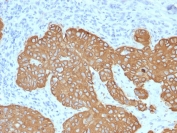 IHC staining of FFPE human basal cell carcinoma with Cytokeratin 5 antibody (clone KRT5/2080). HIER: boil tissue sections in pH 9 10mM Tris with 1mM EDTA for 20 min and allow to cool before testing.