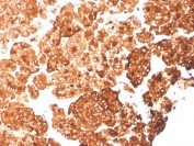 IHC staining of FFPE human pancreas with recombinant Cytokeratin 6A antibody (clone rKRT6A/2100). HIER: boil tissue sections in pH 9 10mM Tris with 1mM EDTA for 20 min and allow to cool before testing.