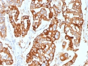 IHC staining of FFPE human ovarian carcinoma with Cytokeratin 7 antibody (clone KRT7/2200). HIER: boil tissue sections in pH 9 10mM Tris with 1mM EDTA for 20 min and allow to cool before testing.