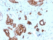 IHC staining of FFPE human breast carcinoma with Cytokeratin 7 antibody (clone KRT7/2200). HIER: boil tissue sections in pH 9 10mM Tris with 1mM EDTA for 20 min and allow to cool before testing.