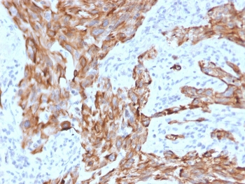 IHC staining of FFPE human lung carcinoma with Cytokeratin 7 antibody (clone KRT7/2200). HIER: boil tissue sections in pH 9 10mM Tris with 1mM EDTA for 20 min and allow to cool before testing.