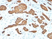 IHC staining of FFPE human skin basal cell carcinoma with Cytokeratin 8 antibody (clone KRT8/2115). HIER: boil tissue sections in pH 9 10mM Tris with 1mM EDTA for 20 min and allow to cool before testing.