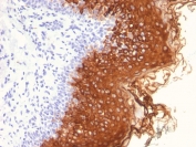 IHC staining of FFPE human skin with Cytokeratin 10 antibody (clone AE20). HIER: boil tissue sections in pH 9 10mM Tris with 1mM EDTA for 20 min and allow to cool before testing.