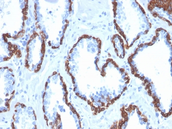 IHC staining of FFPE human prostate carcinoma with Cytokeratin 13 antibody (clone KRT13/2213). HIER: boil tissue sections in pH 9 10mM Tris with 1mM EDTA for 20 min and allow to cool before testing.