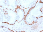 IHC staining of FFPE human prostate carcinoma with Cytokeratin 14 antibody (clone KRT14/2375). HIER: boil tissue sections in pH 9 10mM Tris with 1mM EDTA for 20 min and allow to cool before testing.