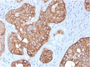 IHC staining of FFPE human colon carcinoma with Cytokeratin 15 antibody (clone KRT15/2957). HIER: boil tissue sections in pH 9 10mM Tris with 1mM EDTA for 10-20 min and allow to cool before testing.