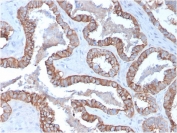 IHC staining of FFPE human prostate carcinoma with Cytokeratin 15 antibody (clone KRT15/2957). HIER: boil tissue sections in pH 9 10mM Tris with 1mM EDTA for 10-20 min and allow to cool before testing.