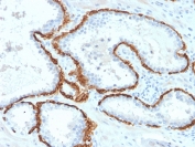 IHC staining of FFPE human prostate carcinoma with Keratin 15 antibody (clone KRT15/2958). HIER: boil tissue sections in pH 9 10mM Tris with 1mM EDTA for 10-20 min and allow to cool before testing.