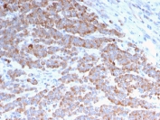IHC staining of FFPE human colon carcinoma with recombinant Cytokeratin 18 antibody (clone rKRT18/1190). HIER: boil tissue sections in pH 9 10mM Tris with 1mM EDTA for 20 min and allow to cool before testing.