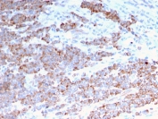 IHC staining of FFPE human colon carcinoma with recombinant Cytokeratin 18 antibody (clone rKRT18/1190). HIER: boil tissue sections in pH 9 10mM Tris with 1mM EDTA for 20 min and allow to cool before testing.