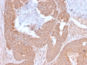 IHC staining of FFPE human colon carcinoma with LAG3 antibody (clone LAG3/3261). HIER: boil tissue sections in pH 9 10mM Tris with 1mM EDTA for 20 min and allow to cool before testing.