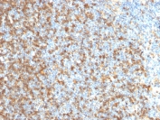 IHC staining of FFPE human follicular lymphoma with LMO2 antibody. HIER: boil tissue sections in pH 9 10mM Tris with 1mM EDTA for 10-20 min and allow to cool before testing.