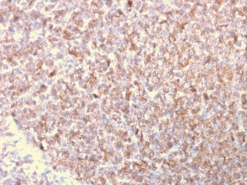 IHC staining of FFPE human lymphoma with LSP1 antibody. HIER: boil tissue sections in pH 9 10mM Tris with 1mM EDTA for 20 min and allow to cool before testing.
