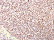 IHC staining of FFPE human lymphoma with LSP1 antibody (clone LSP1/3025). HIER: boil tissue sections in pH 9 10mM Tris with 1mM EDTA for 20 min and allow to cool before testing.