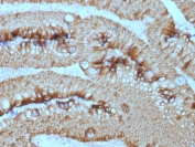 IHC staining of FFPE human rectal mass with EpCAM antibody (clone EGP40/1373). HIER: boil tissue sections in pH 9 10mM Tris with 1mM EDTA for 10-20 min and allow to cool before testing.