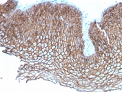 IHC staining of FFPE human esophageal carcinoma with Desmoglein 3 antibody (clone DSG3/2837). HIER: boil tissue sections in pH 9 10mM Tris with 1mM EDTA for 10-20 min and allow to cool before testing.