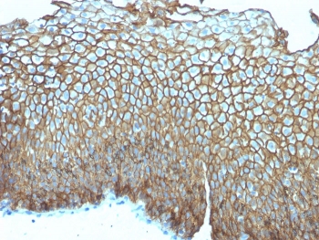 IHC staining of FFPE human esophageal carcinoma with Desmoglein 3 antibody (clone DSG3/2839). HIER: boil tissue sections in pH 9 10mM Tris with 1mM EDTA for 10-20 min and allow to cool before testing.