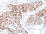 IHC staining of FFPE human breast carcinoma with EpCAM antibody (clone Ber-EP4). HIER: boil tissue sections in pH 9 10mM Tris with 1mM EDTA for 10-20 min and allow to cool before testing.