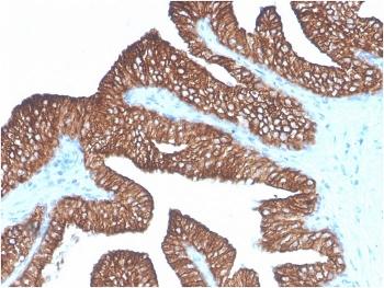 IHC staining of FFPE human prostate carcinoma with EpCAM antibody (clone Ber-EP4). HIER: boil tissue sections in pH 9 10mM Tris with 1mM EDTA for 10-20 min and allow to cool before testing.