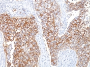 IHC staining of FFPE human breast carcinoma with EpCAM antibody (clone HEA125). HIER: boil tissue sections in pH 9 10mM Tris with 1mM EDTA for 10-20 min and allow to cool before testing.