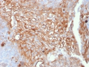 IHC staining of FFPE human urothelial carcinoma with Uroplakin 1A antibody (clone UPK1A/2925). HIER: boil tissue sections in pH 9 10mM Tris with 1mM EDTA for 10-20 min and allow to cool before testing.