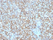 IHC staining of FFPE human melanoma with MCAM antibody (clone MCAM/3048). HIER: boil tissue sections in pH 9 10mM Tris with 1mM EDTA for 20 min and allow to cool before testing.