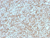 IHC staining of FFPE human melanoma with MCAM antibody (clone MCAM/3048). HIER: boil tissue sections in pH 9 10mM Tris with 1mM EDTA for 20 min and allow to cool before testing.