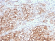 IHC staining of FFPE human melanoma with MCAM antibody (clone MCAM/3046). HIER: boil tissue sections in pH 9 10mM Tris with 1mM EDTA for 20 min and allow to cool before testing.
