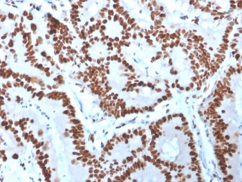 IHC staining of FFPE human colon carcinoma with MCM6 antibody. HIER: boil tissue sections in pH 9 10mM Tris with 1mM EDTA for 20 min and allow to cool before testing.