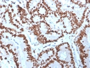 IHC staining of FFPE human colon carcinoma with MCM6 antibody (clone MCM6/3000). HIER: boil tissue sections in pH 9 10mM Tris with 1mM EDTA for 20 min and allow to cool before testing.
