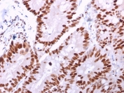 IHC staining of FFPE human colon carcinoma with MCM6 antibody (clone MCM6/2999). HIER: boil tissue sections in pH 9 10mM Tris with 1mM EDTA for 20 min and allow to cool before testing.