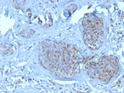 IHC staining of FFPE human breast cancer with MDM2 antibody (clone SMP14). HIER: boil tissue sections in pH 9 10mM Tris with 1mM EDTA for 20 min and allow to cool before testing.