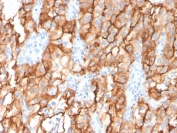 IHC staining of FFPE human renal cell carcinoma with CD10 antibody (clone MME/2579). HIER: boil tissue sections in pH 9 10mM Tris with 1mM EDTA for 20 min and allow to cool before testing.