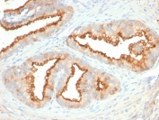 IHC staining of FFPE human prostate carcinoma with CD10 antibody (clone MME/2579). HIER: boil tissue sections in pH 9 10mM Tris with 1mM EDTA for 20 min and allow to cool before testing.