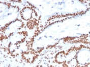 IHC staining of FFPE human colon carcinoma with MSH2 antibody. HIER: boil tissue sections in pH 9 10mM Tris with 1mM EDTA for 20 min and allow to cool before testing.