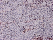 IHC staining of FFPE human colon from a Lynch disease patient with MSH2 antibody. HIER: boil tissue sections in pH 9 10mM Tris with 1mM EDTA for 20 min and allow to cool before testing.