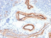 IHC staining of FFPE human renal cell carcinoma with MTF1 antibody (clone MTF1/2649). HIER: boil tissue sections in pH 9 10mM Tris with 1mM EDTA for 20 min and allow to cool before testing.
