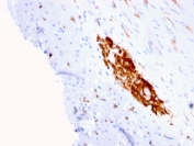 IHC staining of FFPE human colon with NCAM antibody (clone ERIC-1). HIER: boil tissue sections in pH 9 10mM Tris with 1mM EDTA for 20 min and allow to cool before testing.