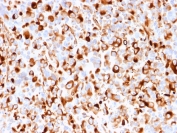 IHC staining of FFPE human melanoma with recombinant NGF Receptor antibody (clone rNGFR/1965). HIER: boil tissue sections in pH 9 10mM Tris with 1mM EDTA for 20 min and allow to cool before testing.