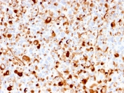 IHC staining of FFPE human melanoma with recombinant NGF Receptor antibody (clone rNGFR/1965). HIER: boil tissue sections in pH 9 10mM Tris with 1mM EDTA for 20 min and allow to cool before testing.